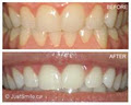 Just Smile - Dental Hygiene and Teeth whitening Services image 6