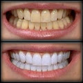 Teeth Whitening Express image 1